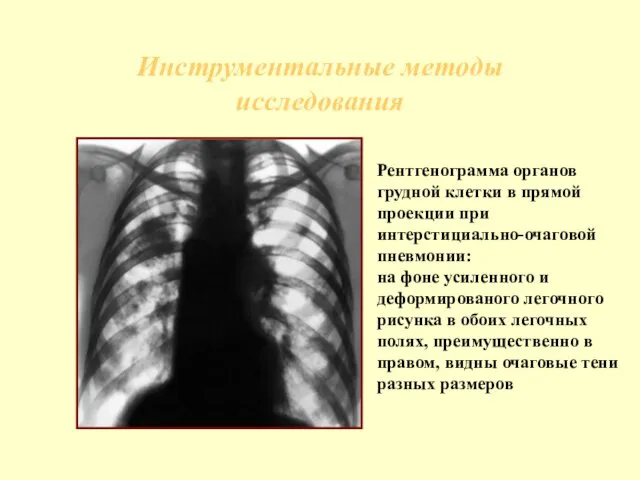 Инструментальные методы исследования Рентгенограмма органов грудной клетки в прямой проекции при