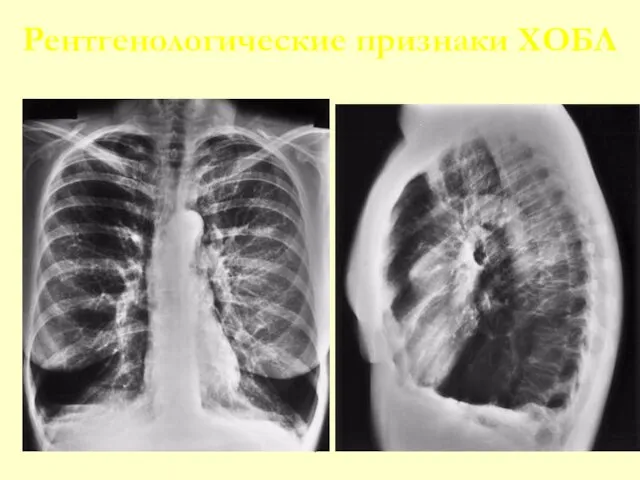 Рентгенологические признаки ХОБЛ