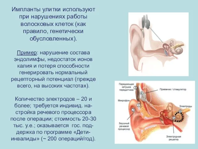 Импланты улитки используют при нарушениях работы волосковых клеток (как правило, генетически