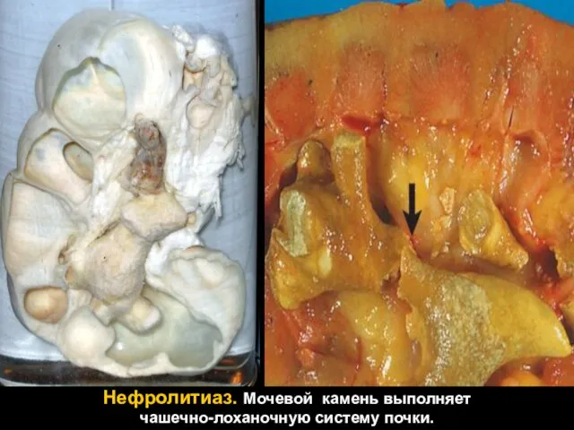 Нефролитиаз. Мочевой камень выполняет чашечно-лоханочную систему почки.