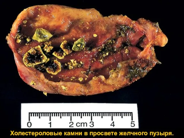 Холестероловые камни в просвете желчного пузыря.