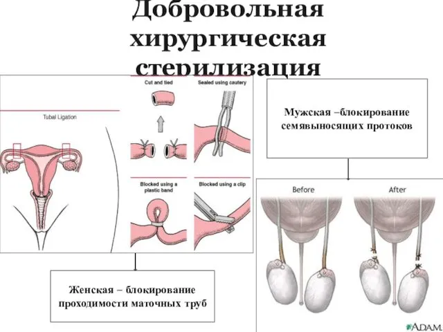 Добровольная хирургическая стерилизация Женская – блокирование проходимости маточных труб Мужская –блокирование семявыносящих протоков