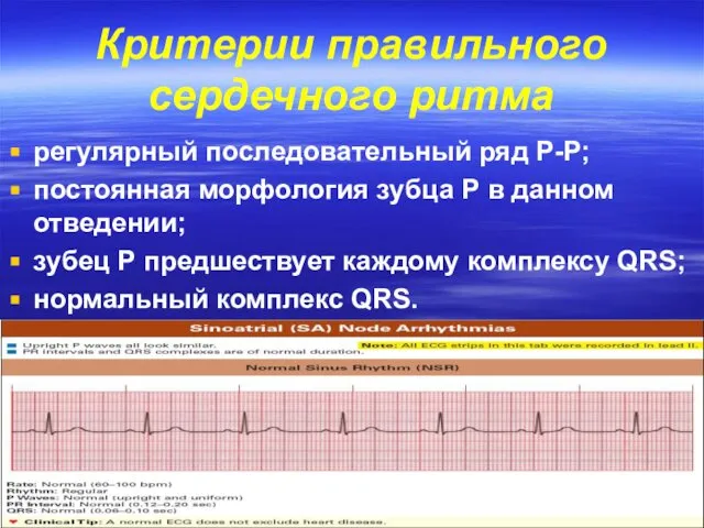 Критерии правильного сердечного ритма регулярный последовательный ряд Р-Р; постоянная морфология зубца