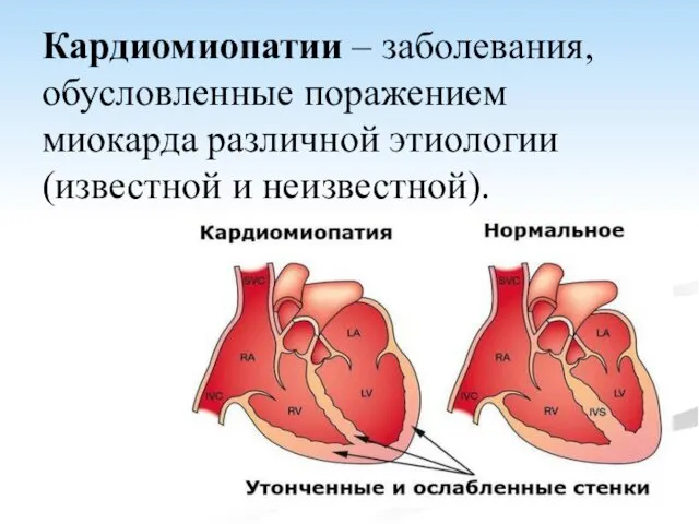 Кардиомиопатии – заболевания, обусловленные поражением миокарда различной этиологии (известной и неизвестной).