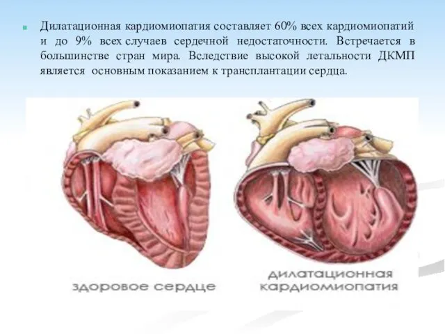 Дилатационная кардиомиопатия составляет 60% всех кардиомиопатий и до 9% всех случаев