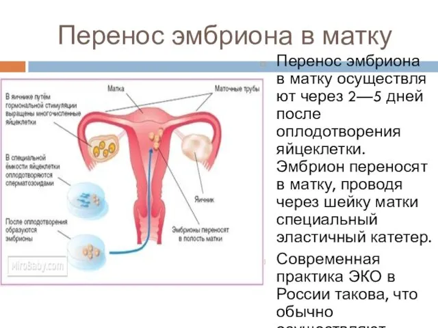 Перенос эмбриона в матку Перенос эмбриона в матку осуществляют через 2—5
