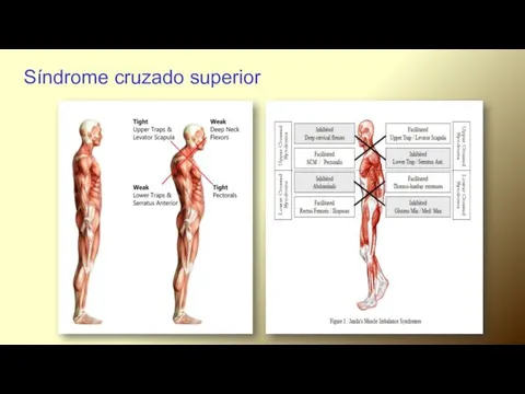 Síndrome cruzado superior.