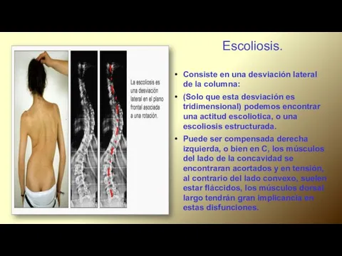 Escoliosis. Consiste en una desviación lateral de la columna: (Solo que