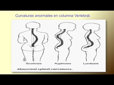 Curvaturas anormales en columna Vertebral.