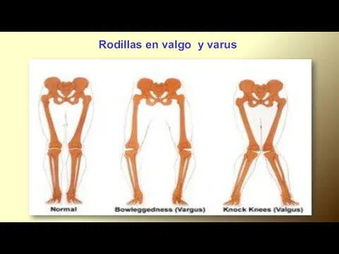 Rodillas en valgo y varus.