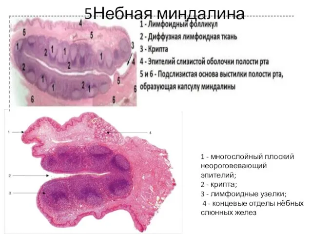 5Небная миндалина 1 - многослойный плоский неороговевающий эпителий; 2 - крипта;