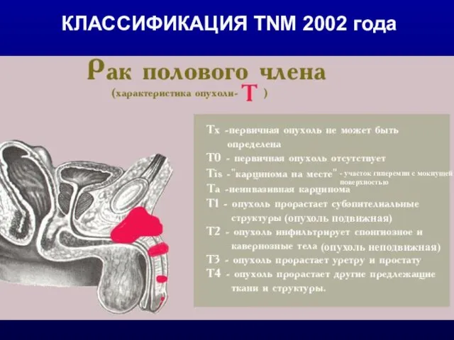 КЛАССИФИКАЦИЯ TNM 2002 года (опухоль подвижная) (опухоль неподвижная) - участок гиперемии с мокнущей поверхностью