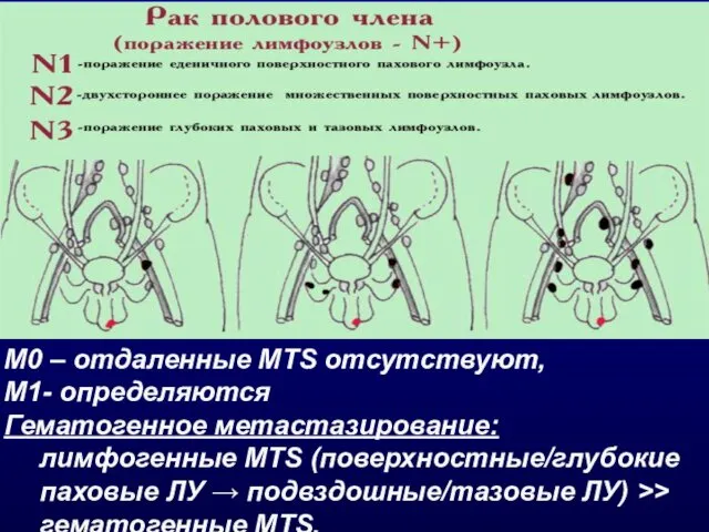 M0 – отдаленные MTS отсутствуют, М1- определяются Гематогенное метастазирование: лимфогенные MTS