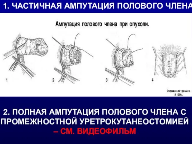 ЧАСТИЧНАЯ АМПУТАЦИЯ ПОЛОВОГО ЧЛЕНА 1. ЧАСТИЧНАЯ АМПУТАЦИЯ ПОЛОВОГО ЧЛЕНА 2. ПОЛНАЯ