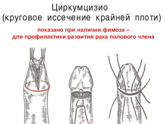 показано при наличии фимоза – для профилактики развития рака полового члена