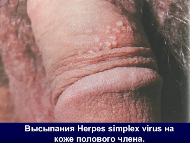 Высыпания Herpes simplex virus на коже полового члена.