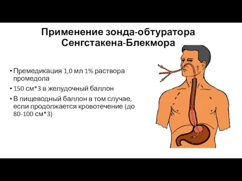 Применение зонда-обтуратора Сенгстакена-Блекмора Премедикация 1,0 мл 1% раствора промедола 150 см*3