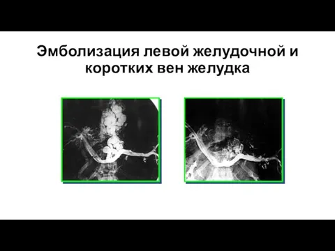 Эмболизация левой желудочной и коротких вен желудка