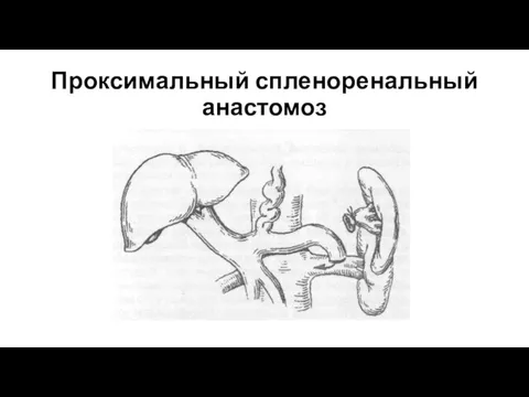 Проксимальный спленоренальный анастомоз