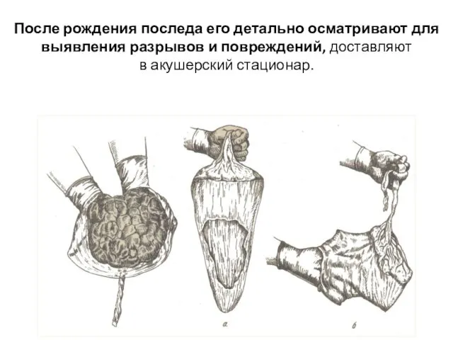 После рождения последа его детально осматривают для выявления разрывов и повреждений, доставляют в акушерский стационар.