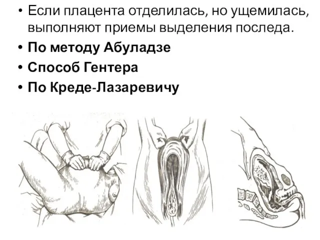 Если плацента отделилась, но ущемилась, выполняют приемы выделения последа. По методу Абуладзе Способ Гентера По Креде-Лазаревичу