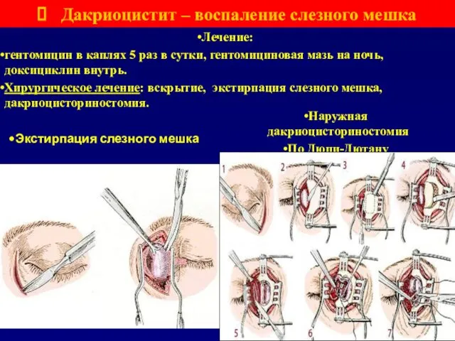 Дакриоцистит – воспаление слезного мешка Лечение: гентомицин в каплях 5 раз