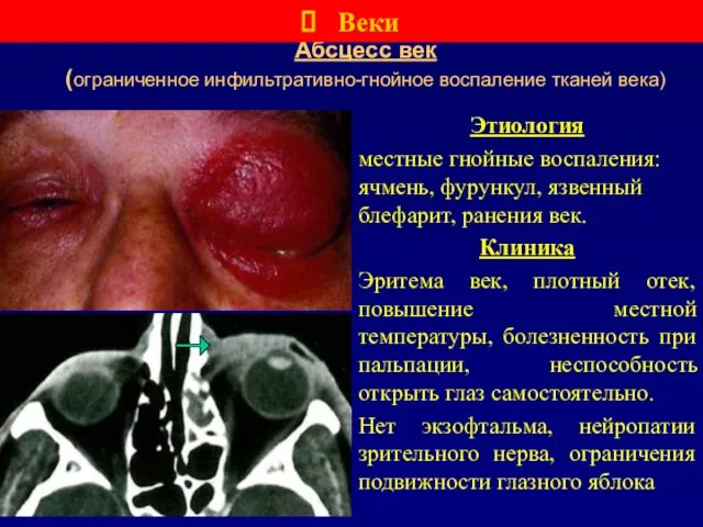 Абсцесс век (ограниченное инфильтративно-гнойное воспаление тканей века) Этиология местные гнойные воспаления: