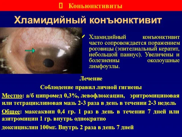 Хламидийный конъюнктивит Хламидийный конъюнктивит часто сопровождается поражением роговицы (эпителиальный кератит, небольшой