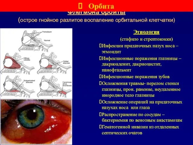 Флегмона орбиты (острое гнойное разлитое воспаление орбитальной клетчатки) Этиология (стафило и