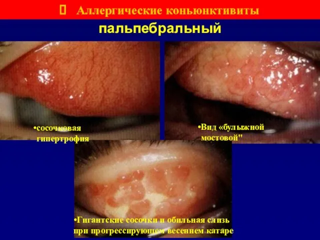 пальпебральный Вид «булыжной мостовой" Гигантские сосочки и обильная слизь при прогрессирующем