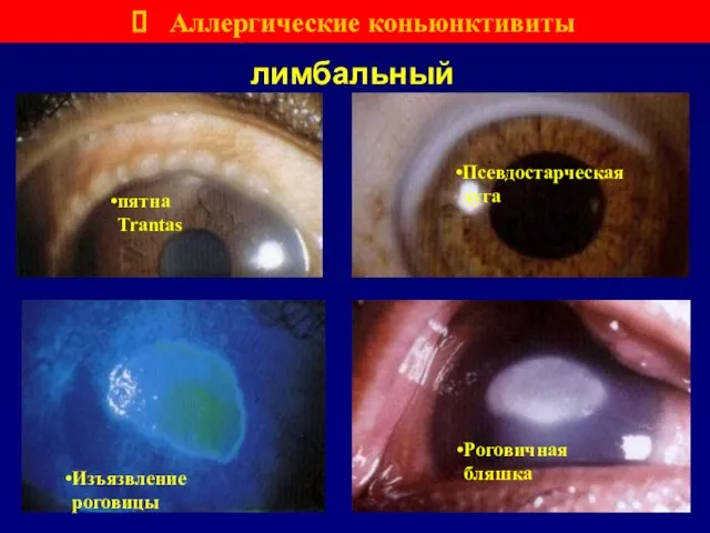 лимбальный пятна Trantas Псевдостарческая дуга Изъязвление роговицы Роговичная бляшка Аллергические коньюнктивиты