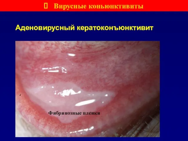 Аденовирусный кератоконъюнктивит Фибринозные пленки Вирусные коньюнктивиты