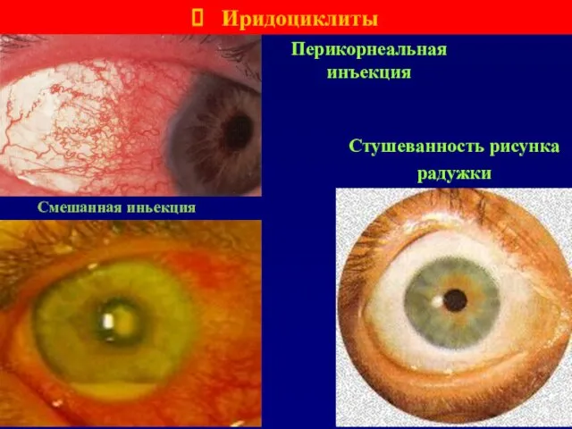 Перикорнеальная инъекция Иридоциклиты Стушеванность рисунка радужки Смешанная иньекция