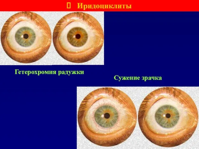 Гетерохромия радужки Иридоциклиты Сужение зрачка