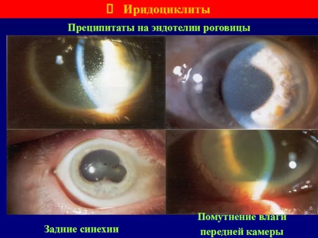 Преципитаты на эндотелии роговицы Иридоциклиты Задние синехии Помутнение влаги передней камеры