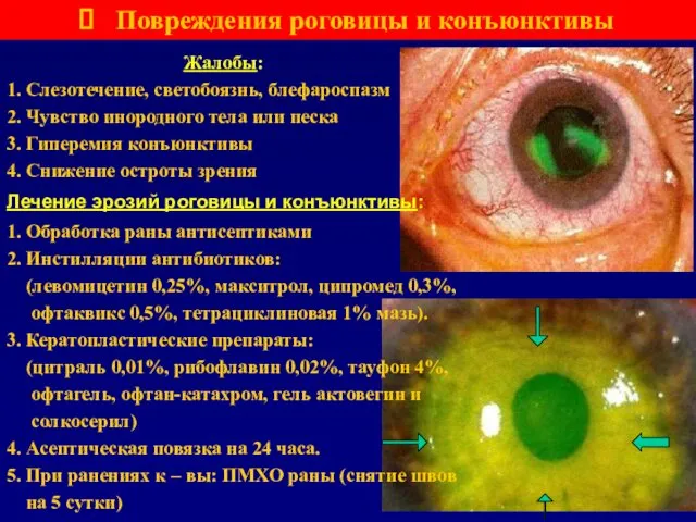 Повреждения роговицы и конъюнктивы Лечение эрозий роговицы и конъюнктивы: 1. Обработка