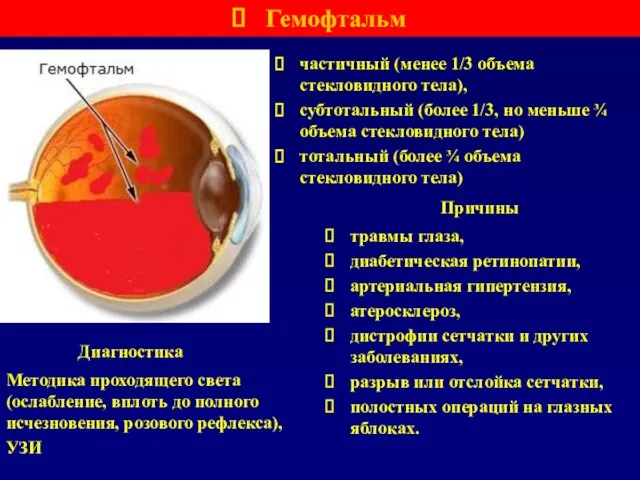 Гемофтальм частичный (менее 1/3 объема стекловидного тела), субтотальный (более 1/3, но