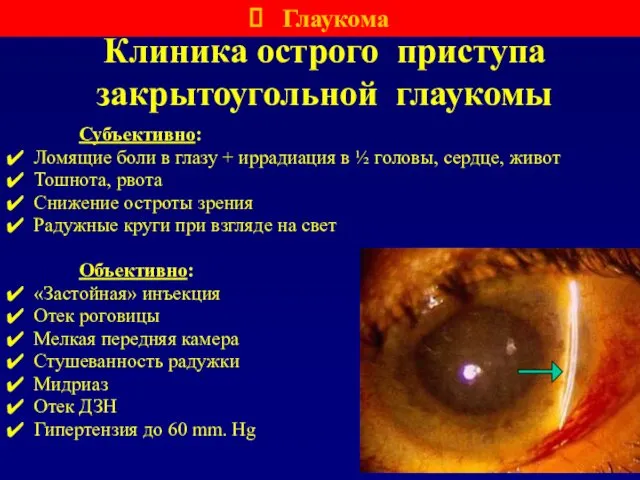 Клиника острого приступа закрытоугольной глаукомы Субъективно: Ломящие боли в глазу +