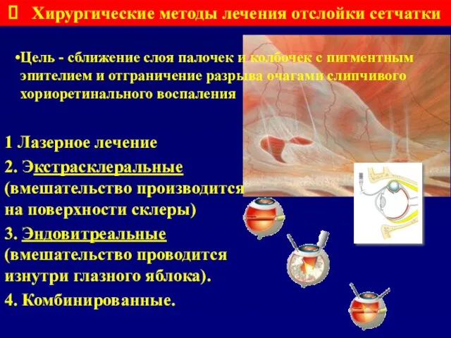 Цель - сближение слоя палочек и колбочек с пигментным эпителием и