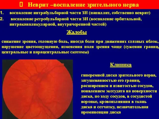 Неврит –воспаление зрительного нерва воспаление интрабульбарной части ЗН (папиллит, собственно неврит)