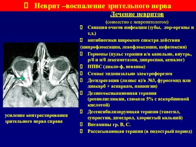 Лечение невритов (совместно с невропатологом) Неврит –воспаление зрительного нерва Санация очагов