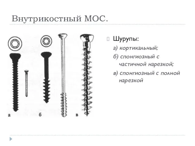 Внутрикостный МОС. Шурупы: а) кортикальный; б) спонгиозный с частичной нарезкой; в) спонгиозный с полной нарезкой