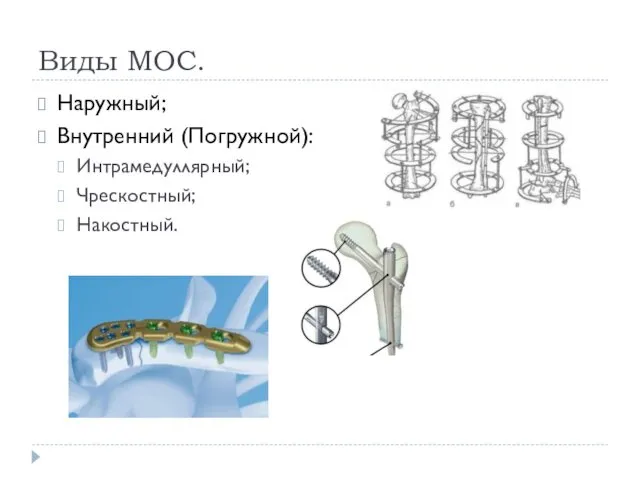 Виды МОС. Наружный; Внутренний (Погружной): Интрамедуллярный; Чрескостный; Накостный.