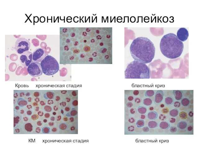 Хронический миелолейкоз Кровь хроническая стадия бластный криз КМ хроническая стадия бластный криз