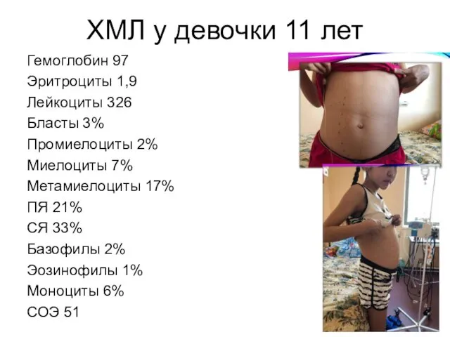 ХМЛ у девочки 11 лет Гемоглобин 97 Эритроциты 1,9 Лейкоциты 326