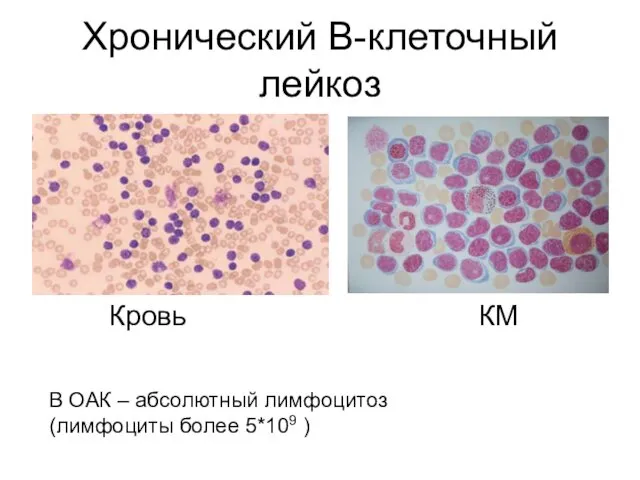 Хронический В-клеточный лейкоз Кровь КМ В ОАК – абсолютный лимфоцитоз (лимфоциты более 5*109 )