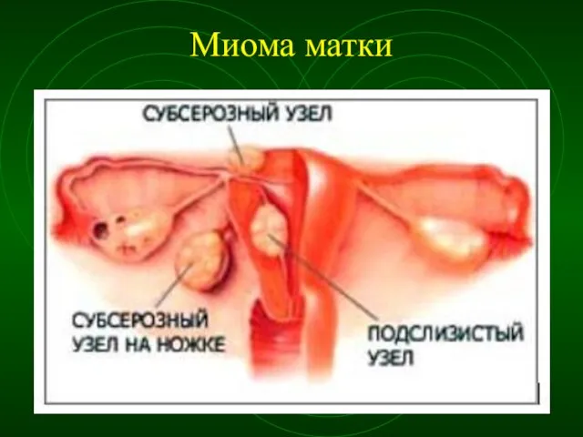 Миома матки