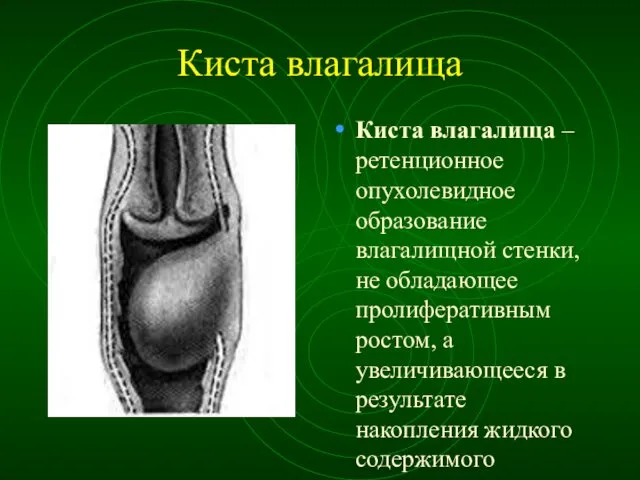 Киста влагалища Киста влагалища – ретенционное опухолевидное образование влагалищной стенки, не