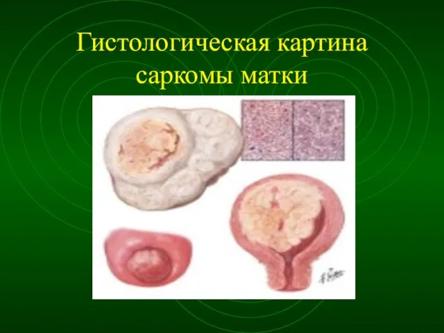 Гистологическая картина саркомы матки