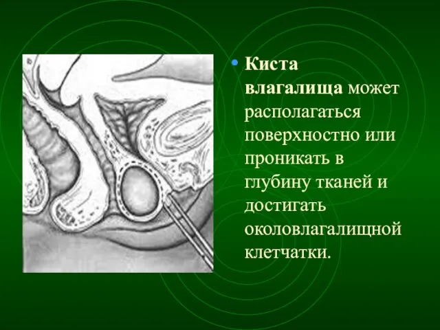 Киста влагалища может располагаться поверхностно или проникать в глубину тканей и достигать околовлагалищной клетчатки.